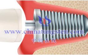 What Are High-Density Tungsten Alloy Medical And Dental Implants?
